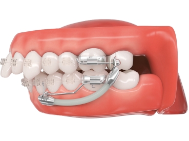 Flex Developer™ 2.0, variable length, 10 pieces for left side