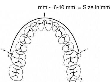 Molaren-Distalisierungs-Bogen, Größe 1 (80 mm)