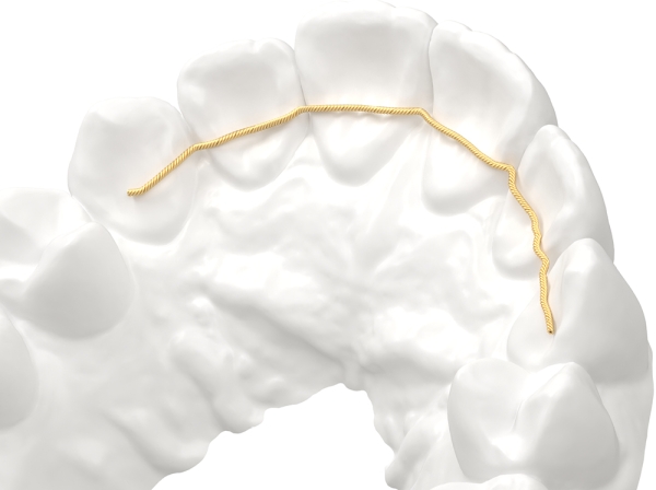 ProTain™ – digital retainer, upper jaw
